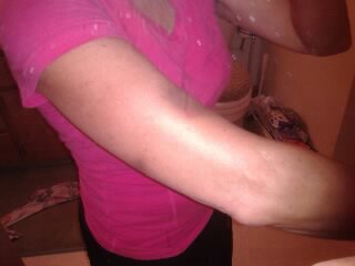picture of bruised arm from lightning strike
